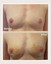 Alloclae® Breast Lift & Enhancement