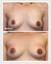 Alloclae® Breast Lift & Enhancement