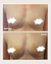 Alloclae® Breast Lift & Enhancement