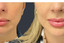 Lipoderma® Fat Restoration