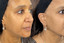 Lipoderma® Fat Restoration