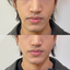 JawlineFix: Filler