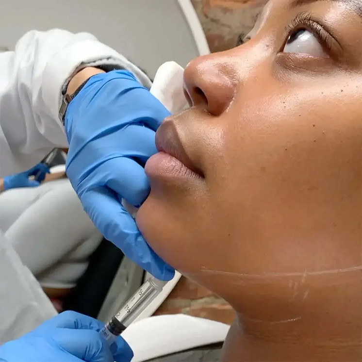ChinFix: Kybella