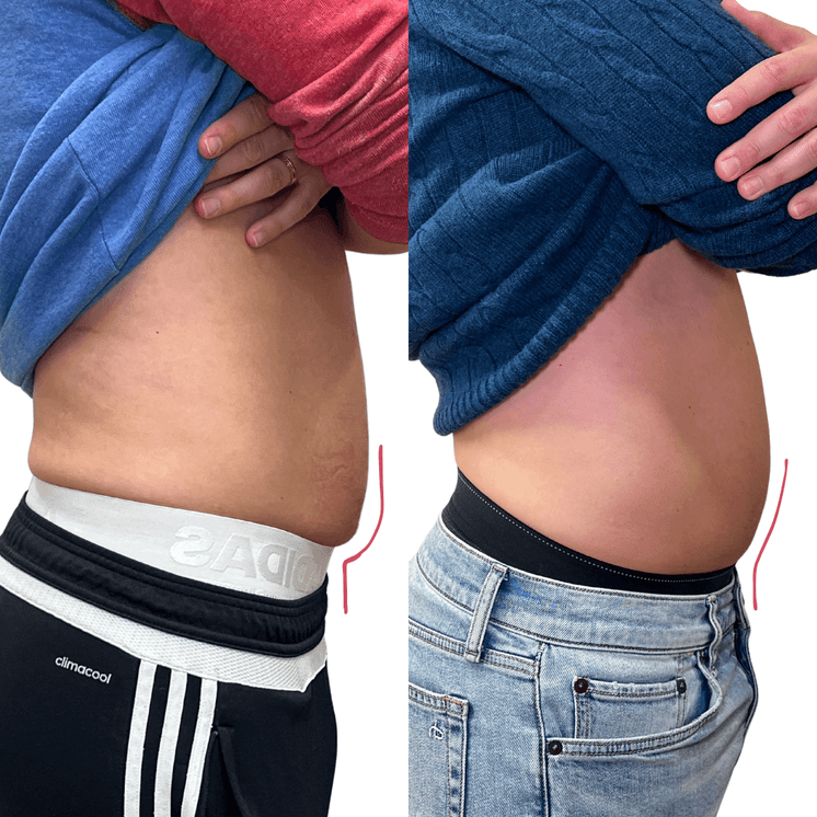 BodyFix: Kybella