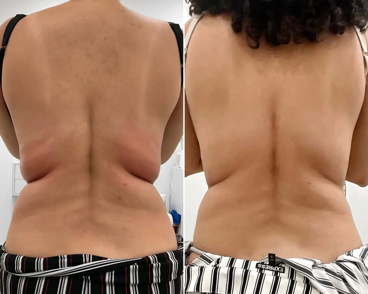 BodyFix: Kybella