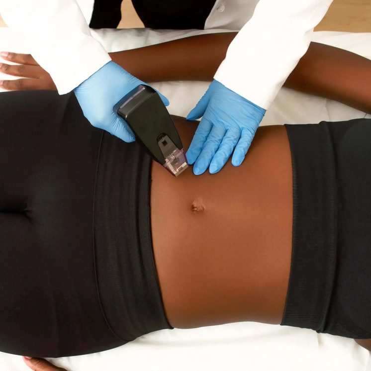 BodyFix: Morpheus8