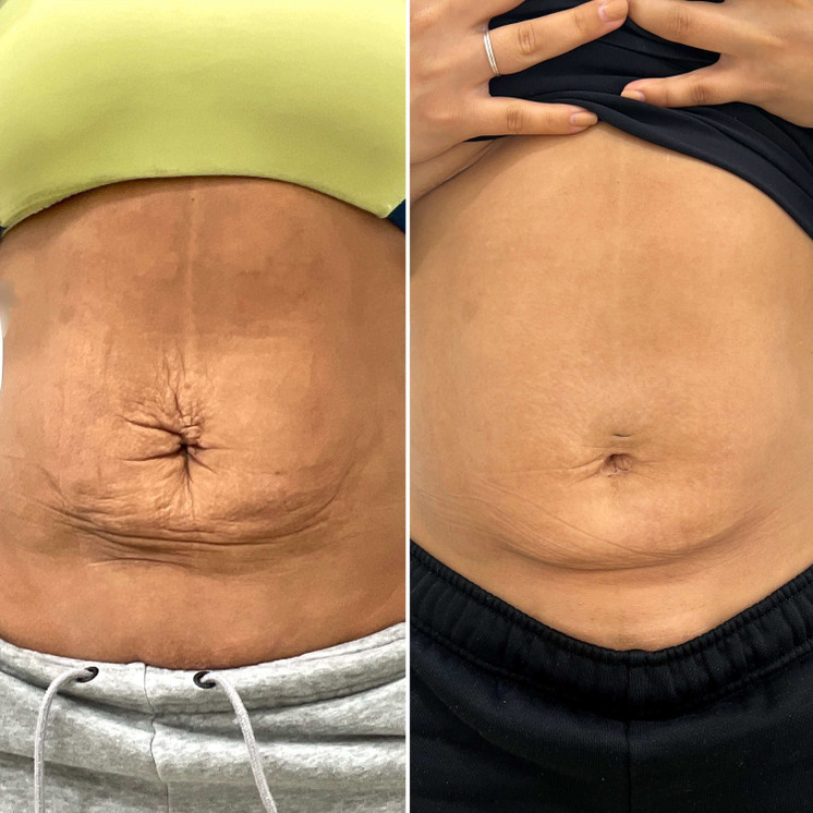 BodyFix: Morpheus8