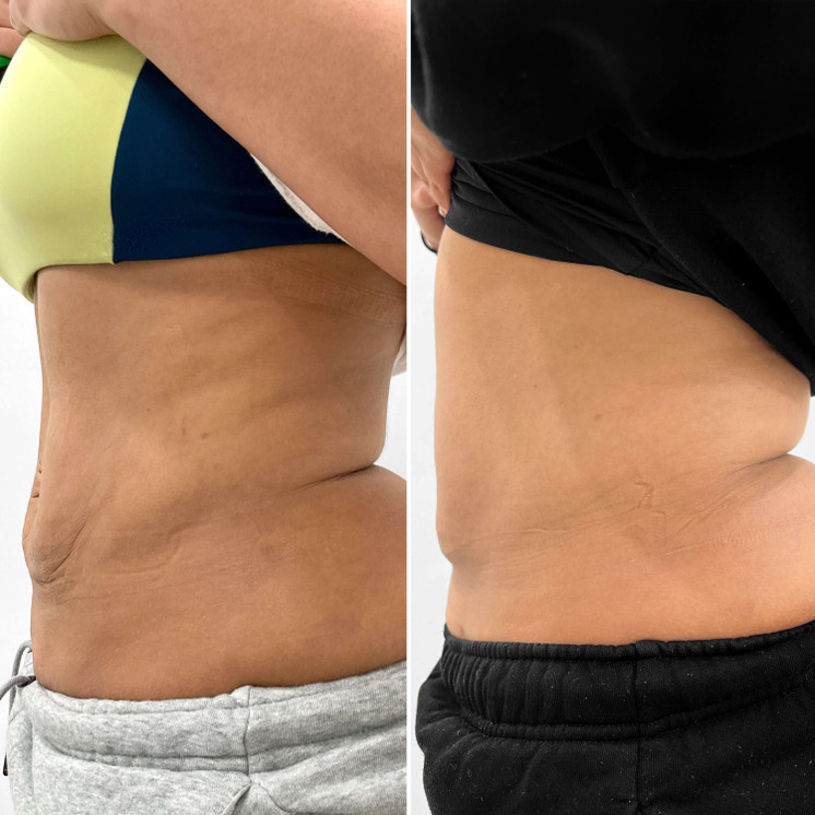 BodyFix: Morpheus8