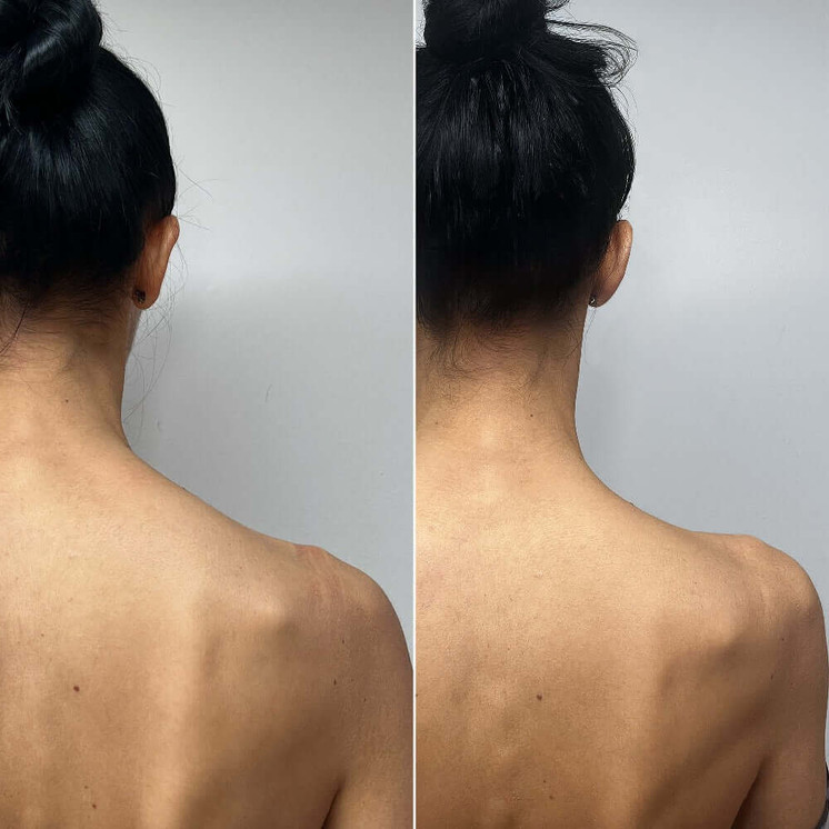 BodyFix: TrapTox