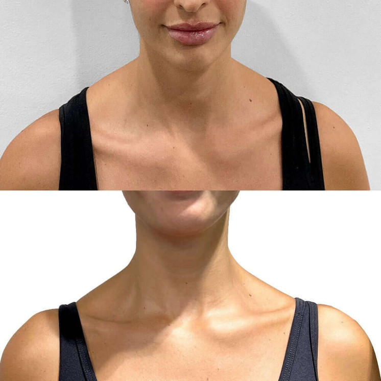 BodyFix: TrapTox