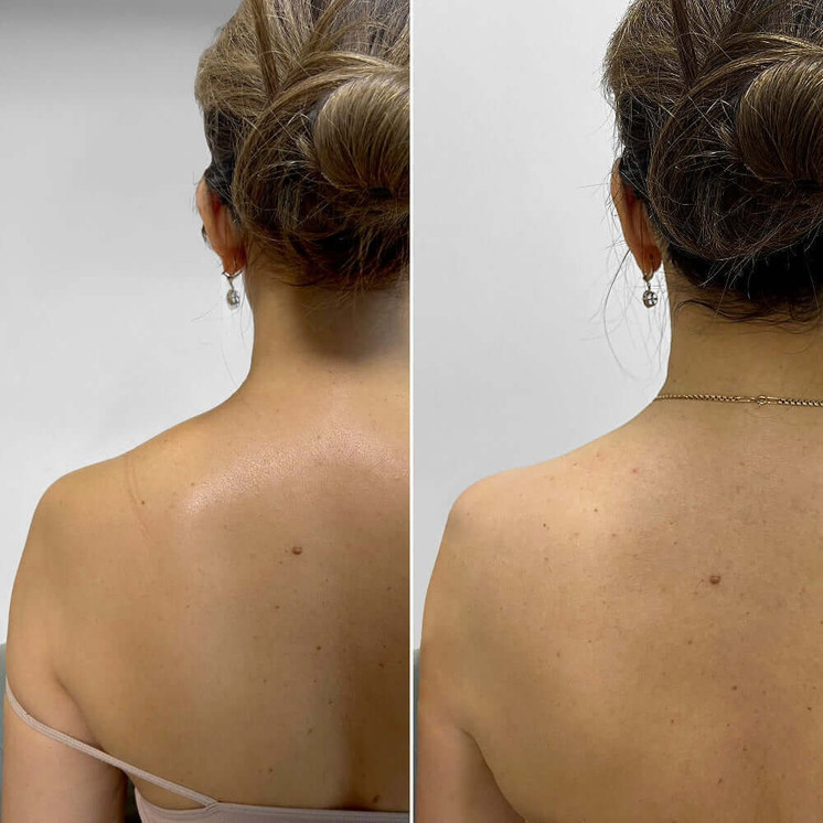 BodyFix: TrapTox