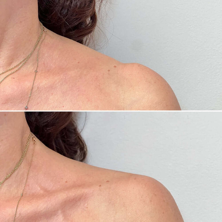 BodyFix: TrapTox