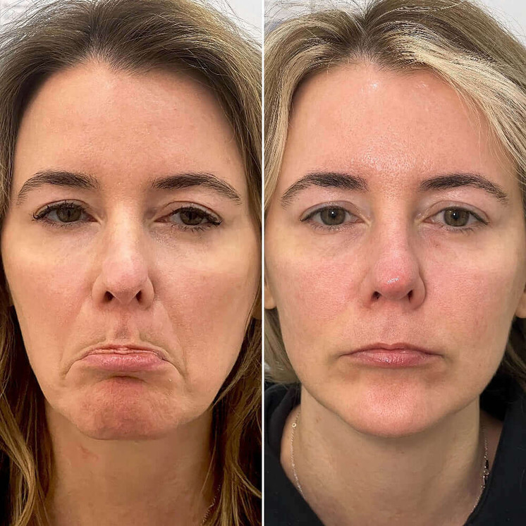 ChinFix: Botox