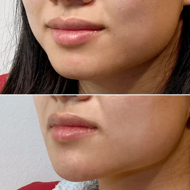 ChinFix: Filler