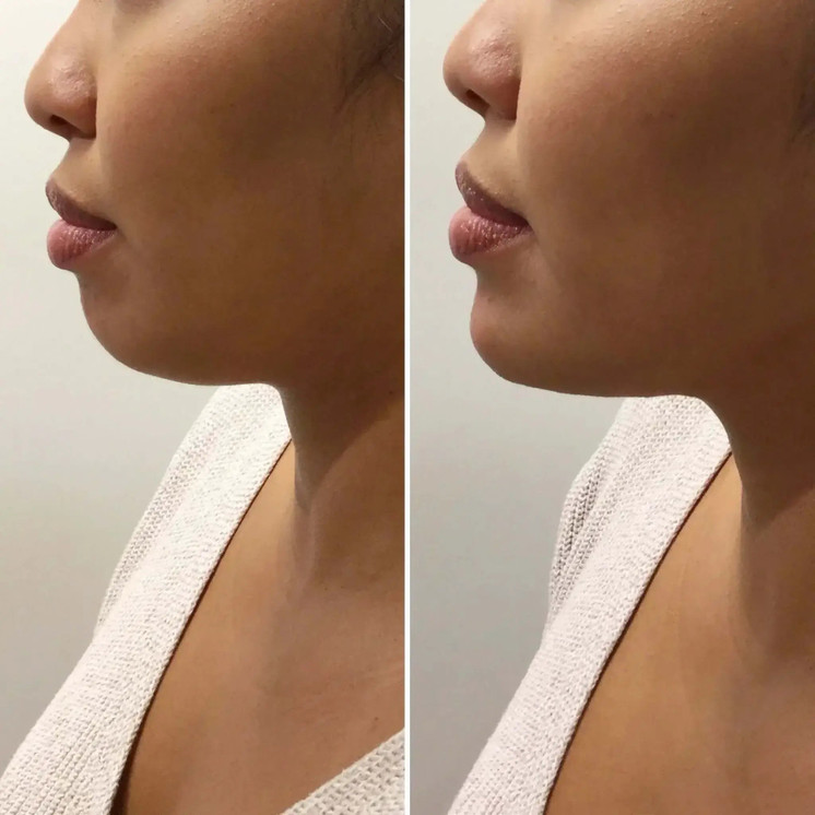 ChinFix: Filler