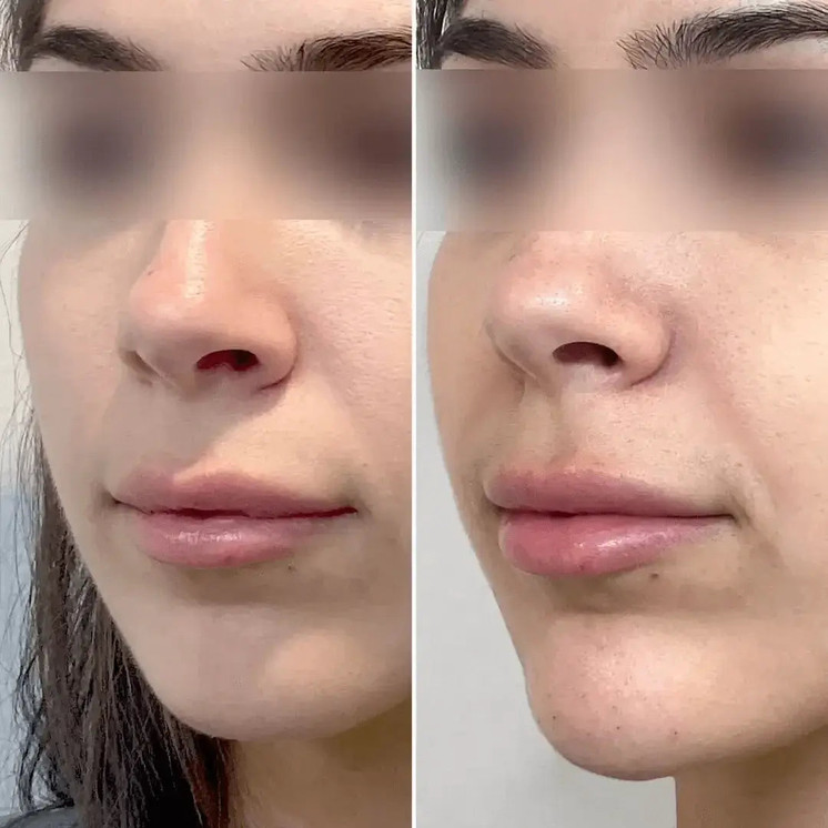 ChinFix: Filler