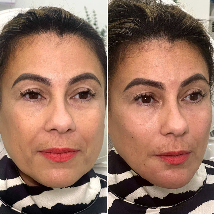 ChinFix: Filler