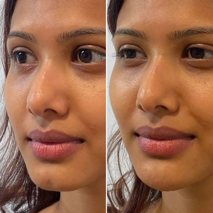 ChinFix: Filler