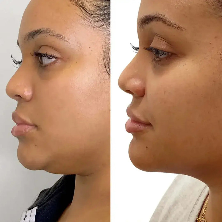 ChinFix: Liposuction