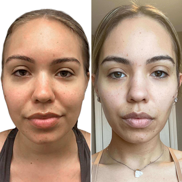 ChinFix: Liposuction