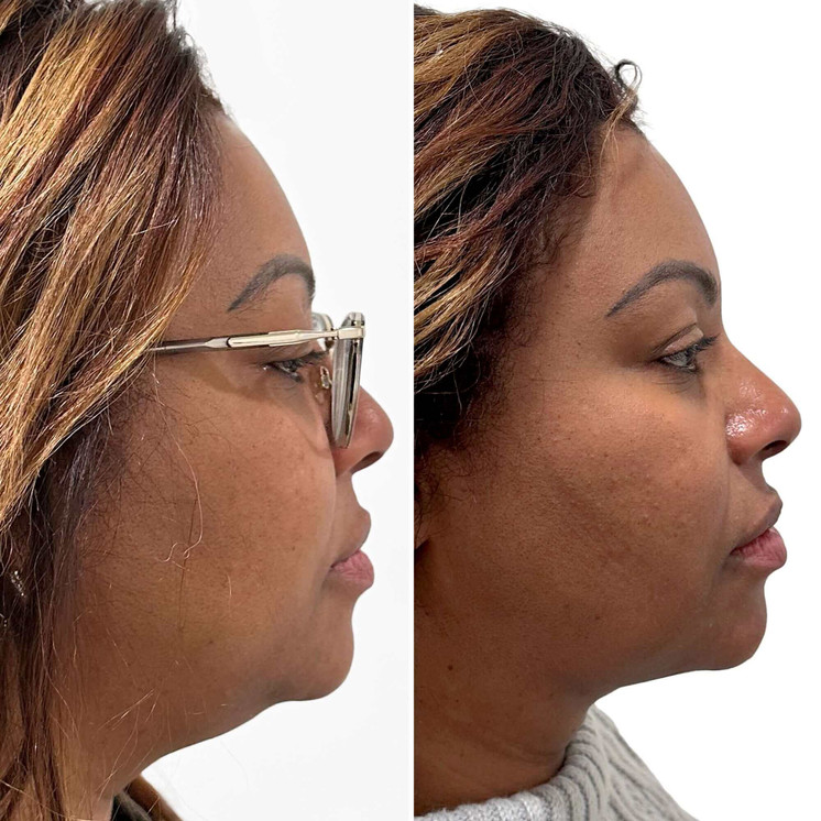 ChinFix: Liposuction