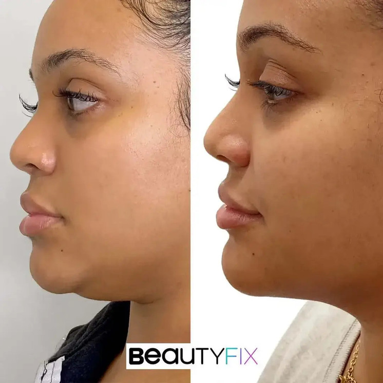 ChinFix: Liposuction