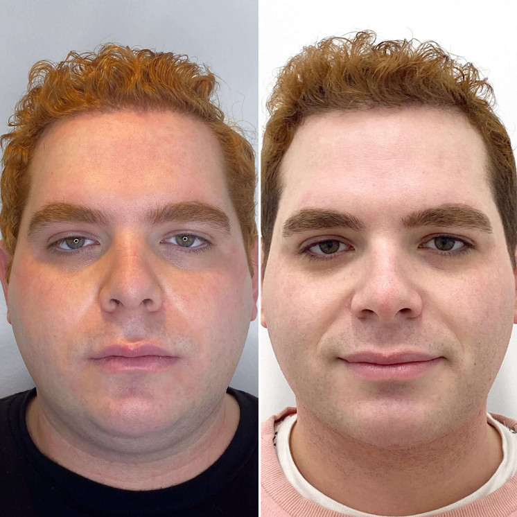 ChinFix: truSculpt iD