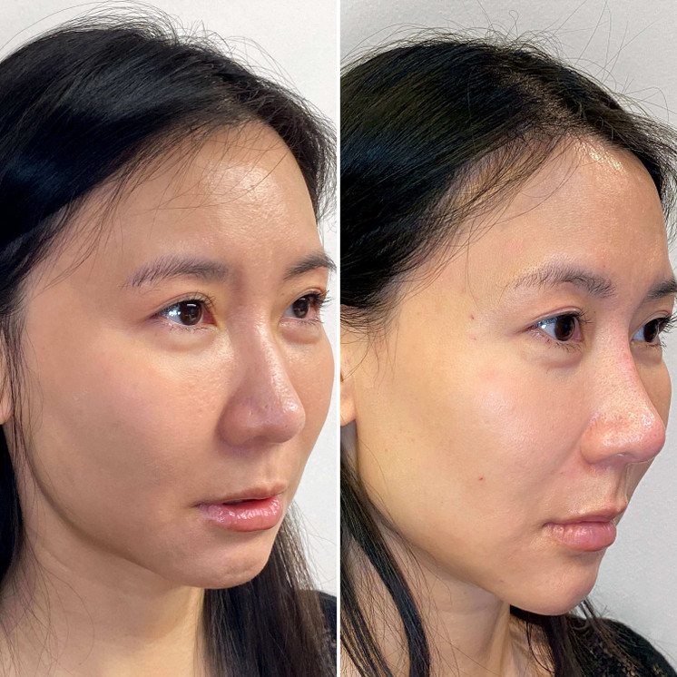 FaceFix: Liquid Face Lift