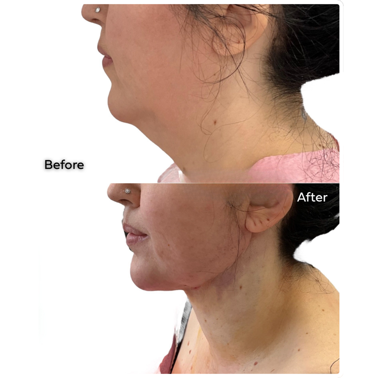 FaceFix: M-Lift