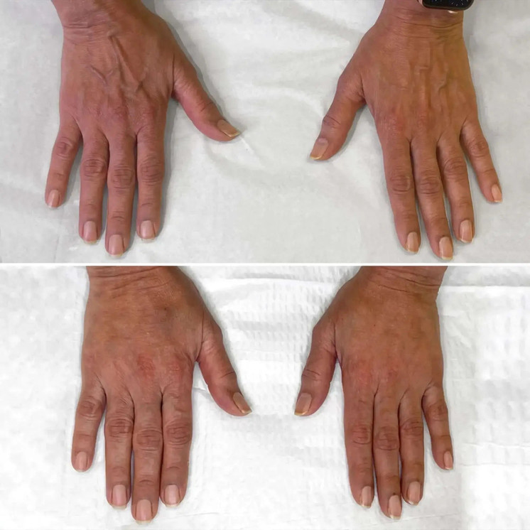 HandFix: Filler