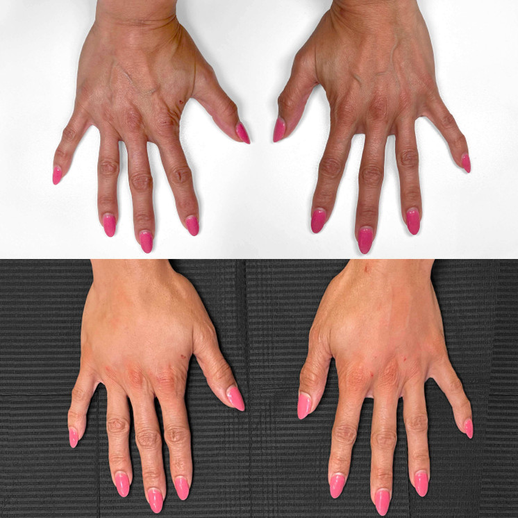 HandFix: Filler