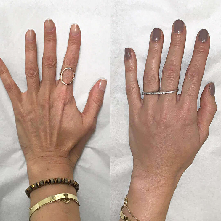 HandFix: Filler