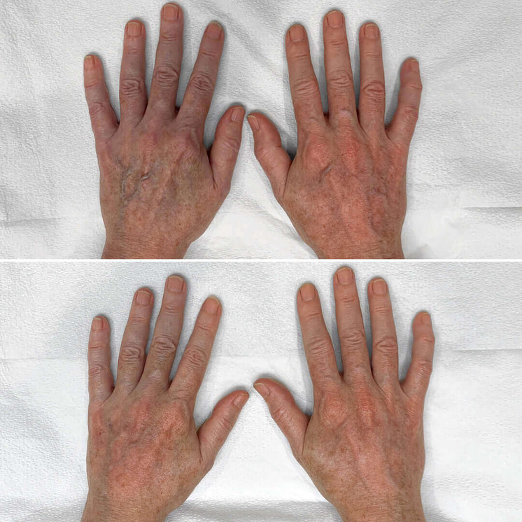 HandFix: Filler