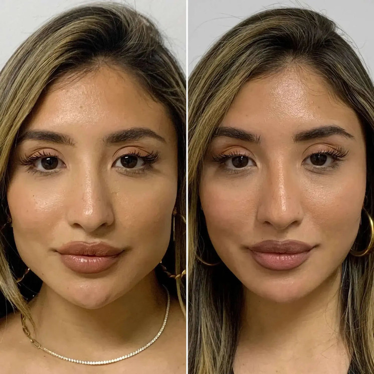 JawlineFix: Masseter Botox