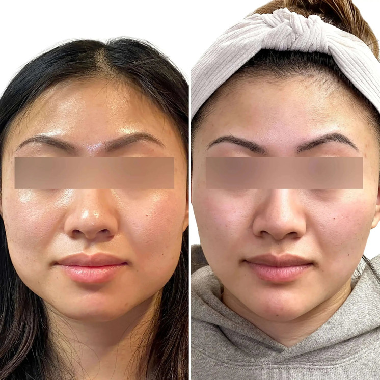 JawlineFix: Masseter Botox