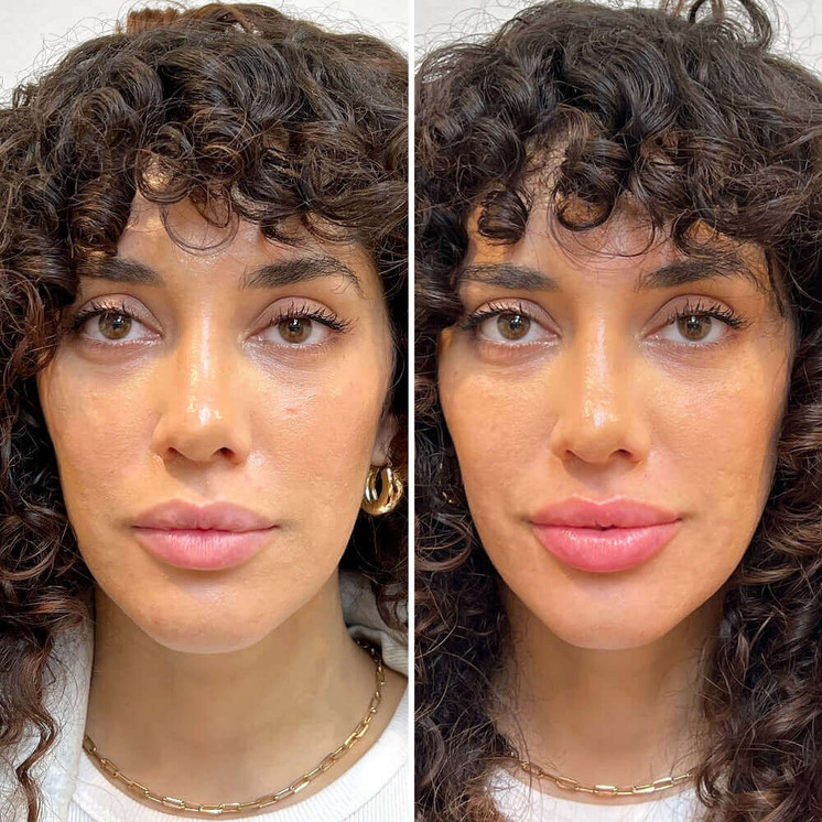 LipFix: Filler