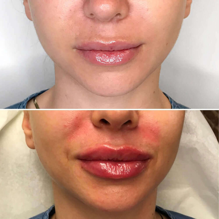 LipFix: Filler