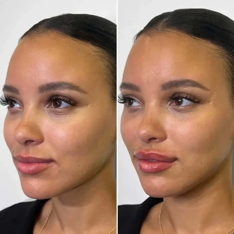 LipFix: Filler