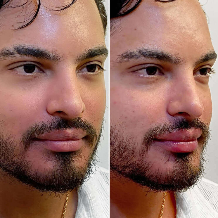 LipFix: Filler