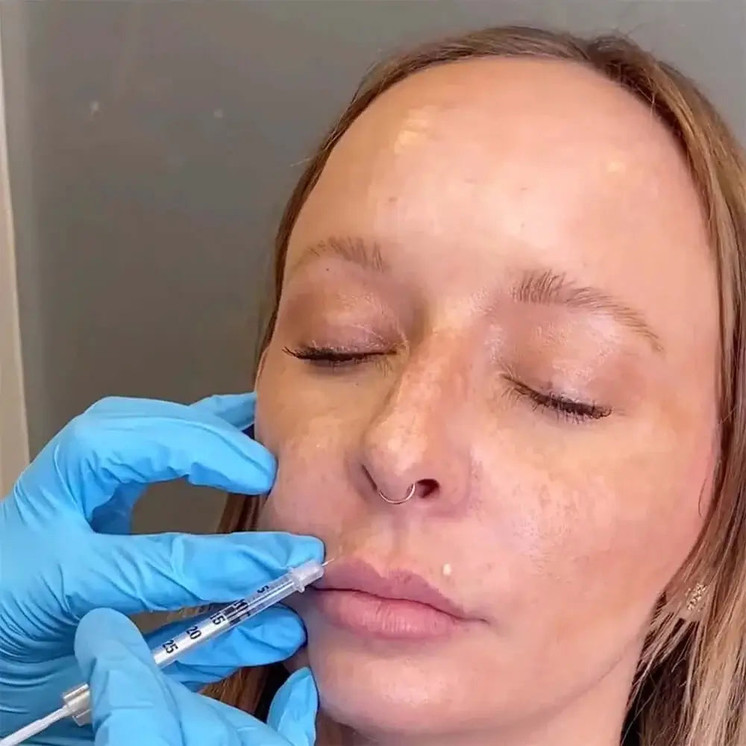 LipFix: LipFlip