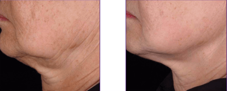 Microneedling