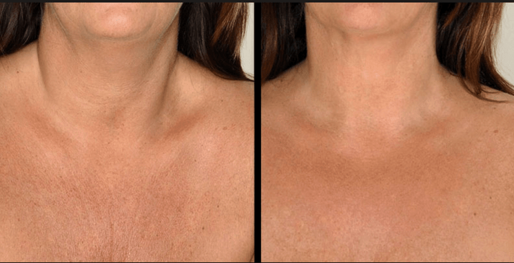 Microneedling
