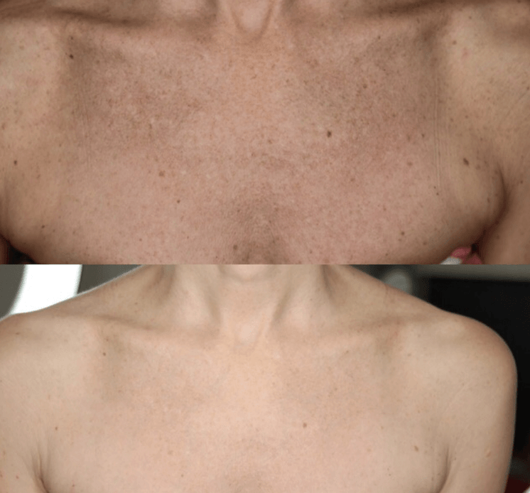 Microneedling