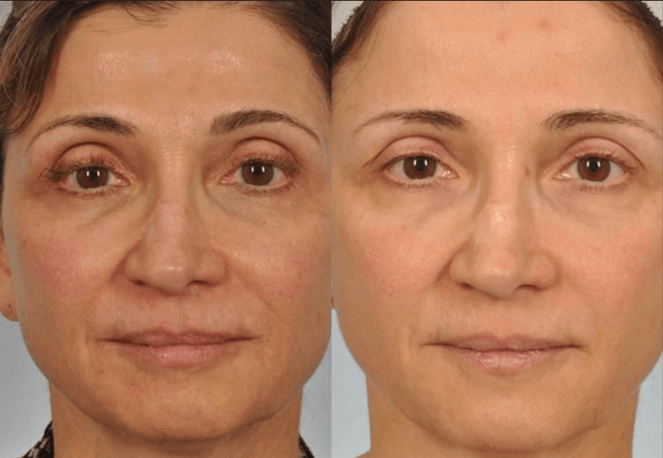 Microneedling