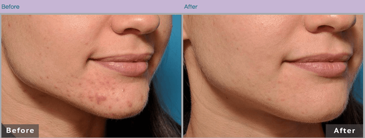 Microneedling