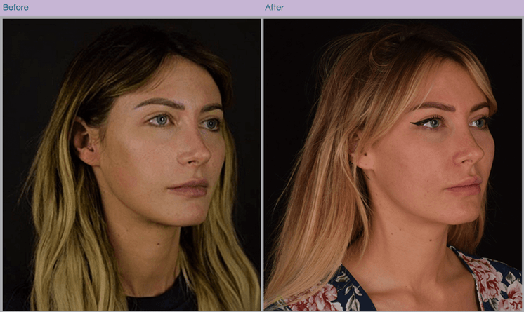 Microneedling