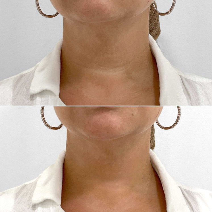 NeckFix: Filler