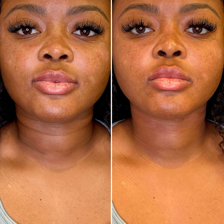 NeckFix: Filler