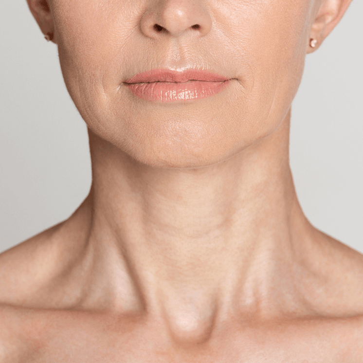 NeckFix: Nefertiti Lift