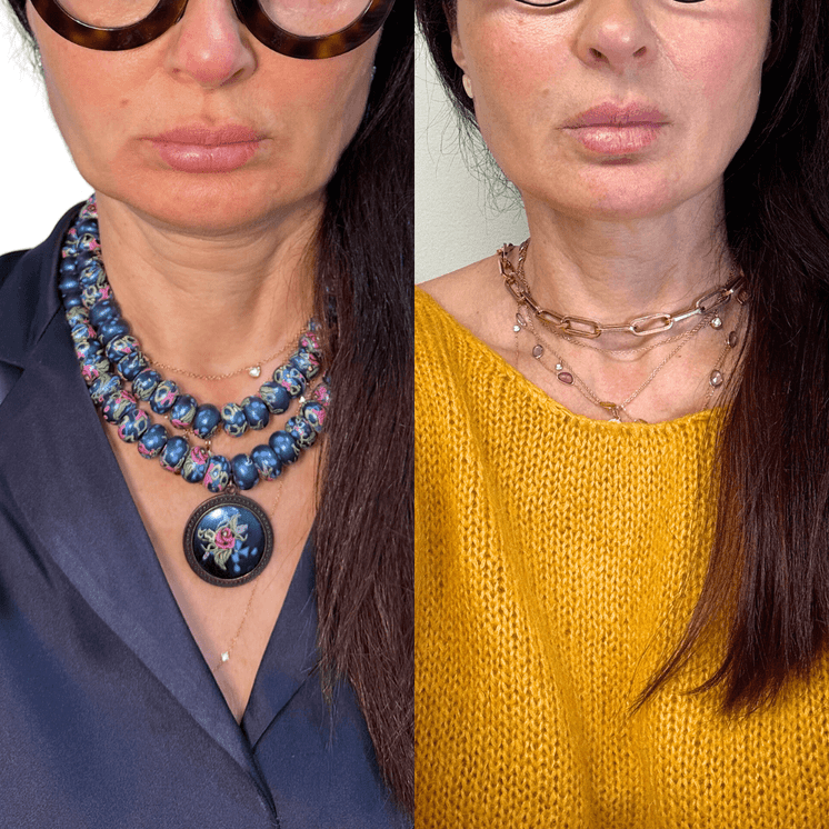 NeckFix: Nefertiti Lift